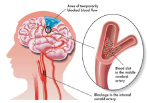 Types of Stroke