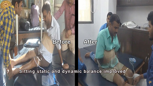 Spnal Cord Injury, Spinal Cord Injury Treatment, Kiran Gojagekar
